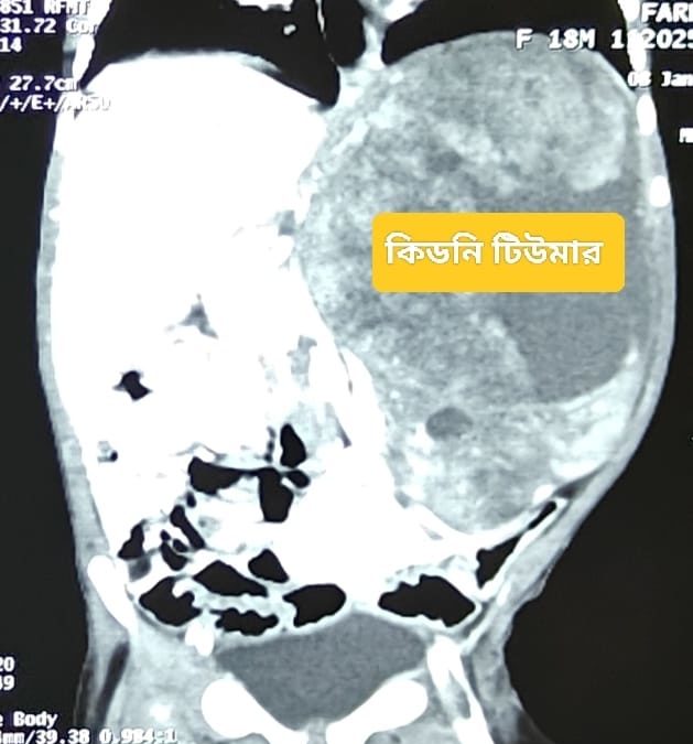 Wilms tumour / Nephroblastoma (শিশুদের কিডনি টিউমার)