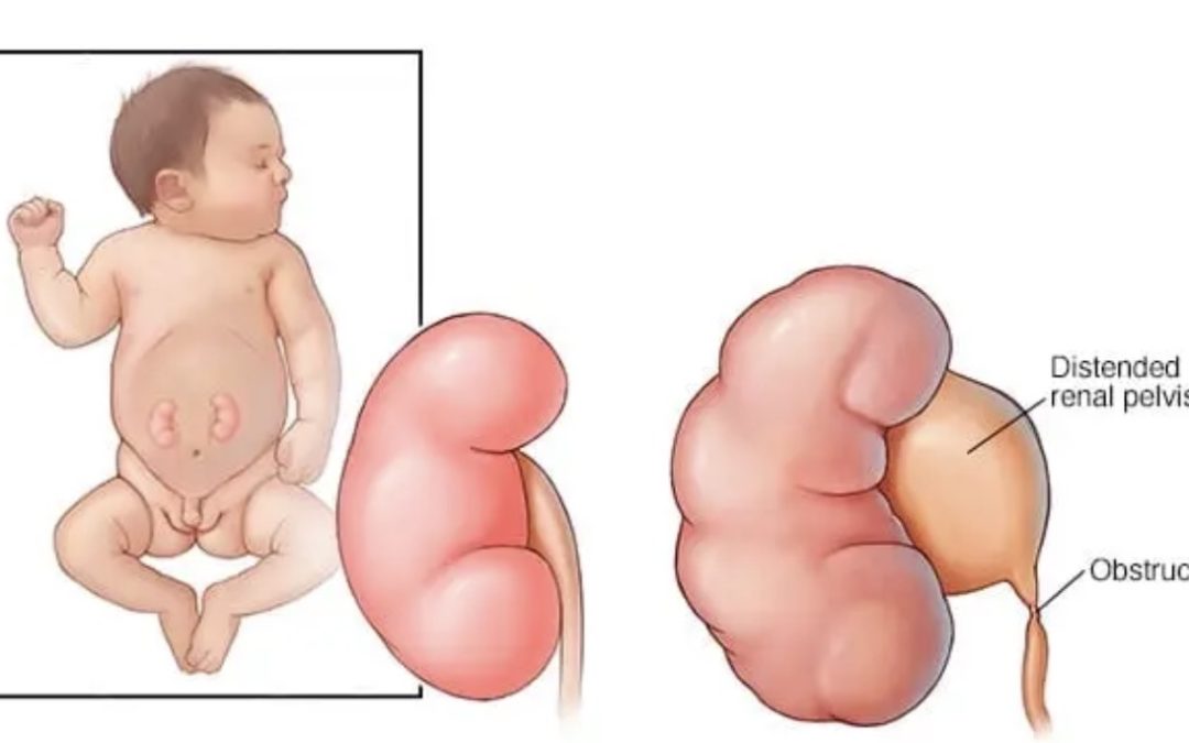 বাচ্চাদের হাইড্রোনেফ্রোসিস (Hydronephrosis): অভিভাবকদের জন্য একটি পূর্ণাঙ্গ গাইড