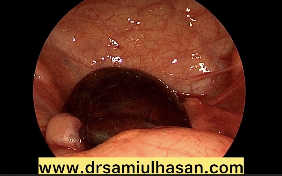 বাচ্চাদের ওভারিয়ান সিস্ট (Ovarian cyst) : অভিভাবকদের জন্য একটি পূর্ণাঙ্গ গাইড